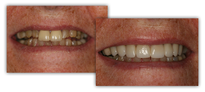 before and after veneers Grand Rapids